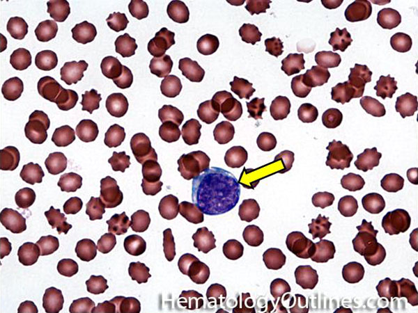 HematologyOutlines Glossary