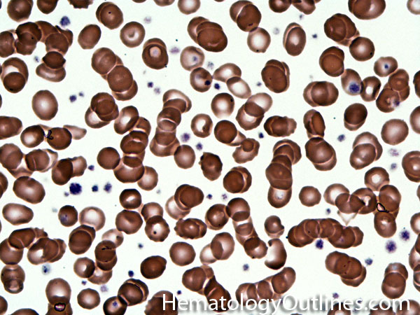 Hematologyoutlines Atlas